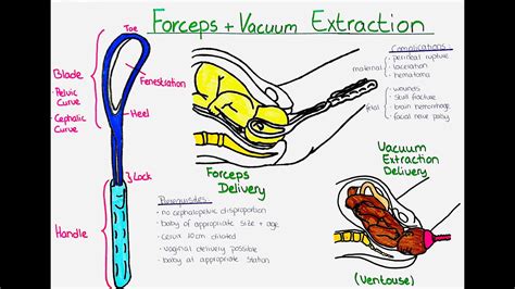 ventouse double face|indications of forceps delivery.